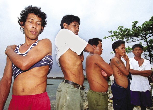 Des hommes de Baseco, un bidonville de Manille, aux Philippines, montrent leurs cicatrices de ventes de rein.